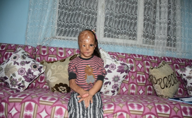 Bebekken yüzü yanan 5 yaşındaki Dilara'ya AA'nın haberiyle yardım eli uzandı